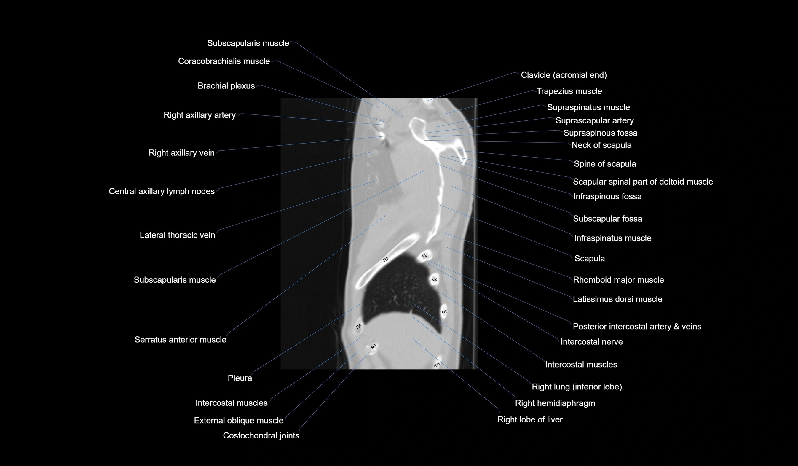 CT chest (thorax) lung window labelled sagittal cross sectional anatomy radiology image-00018.webp